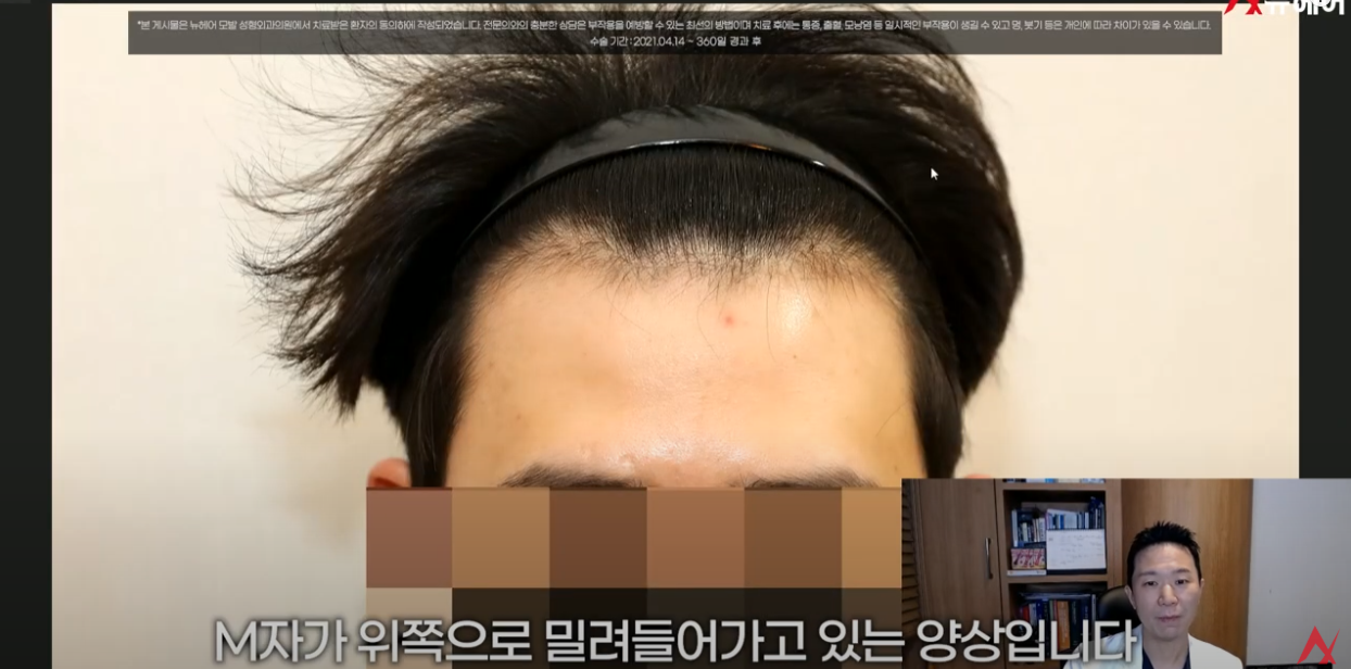 M자 헤어라인 비교