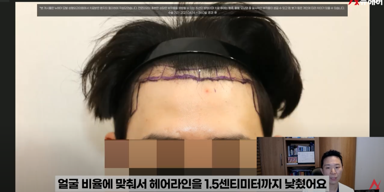 남성형 탈모, M자 헤어라인 비교