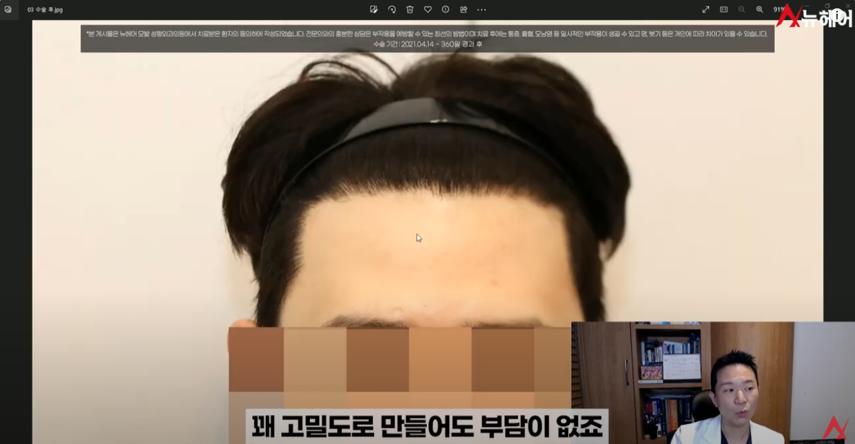 M자 헤어라인 비교 전후 사진