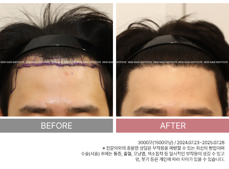 M자 헤어라인 비교 전후 사진 2