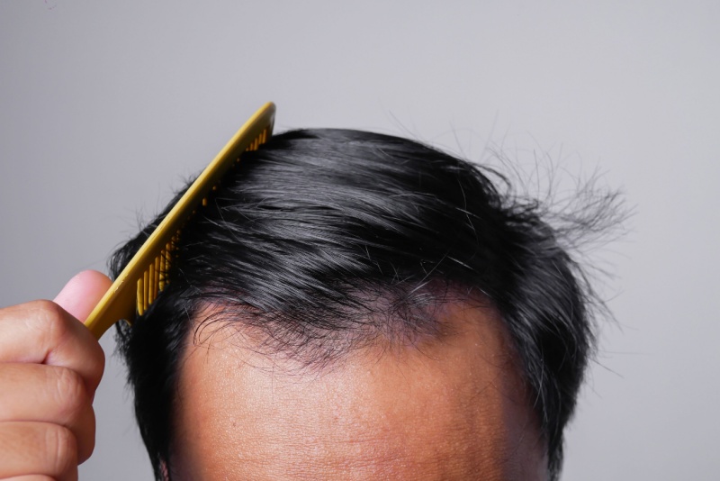 M자 탈모에 효과적인 치료 방법
