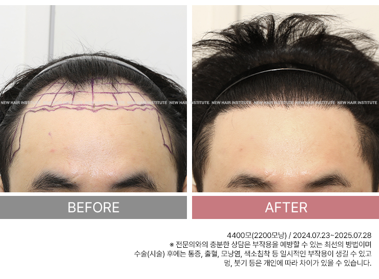 모발이식 탈모 치료