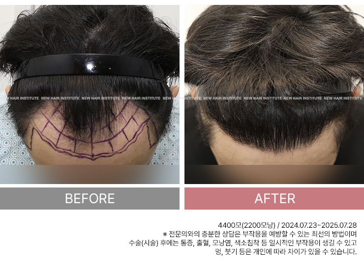 M자 탈모 치료법, 모발이식