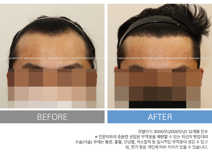 4000모 모발 이식 후 12개월 경과 사례
