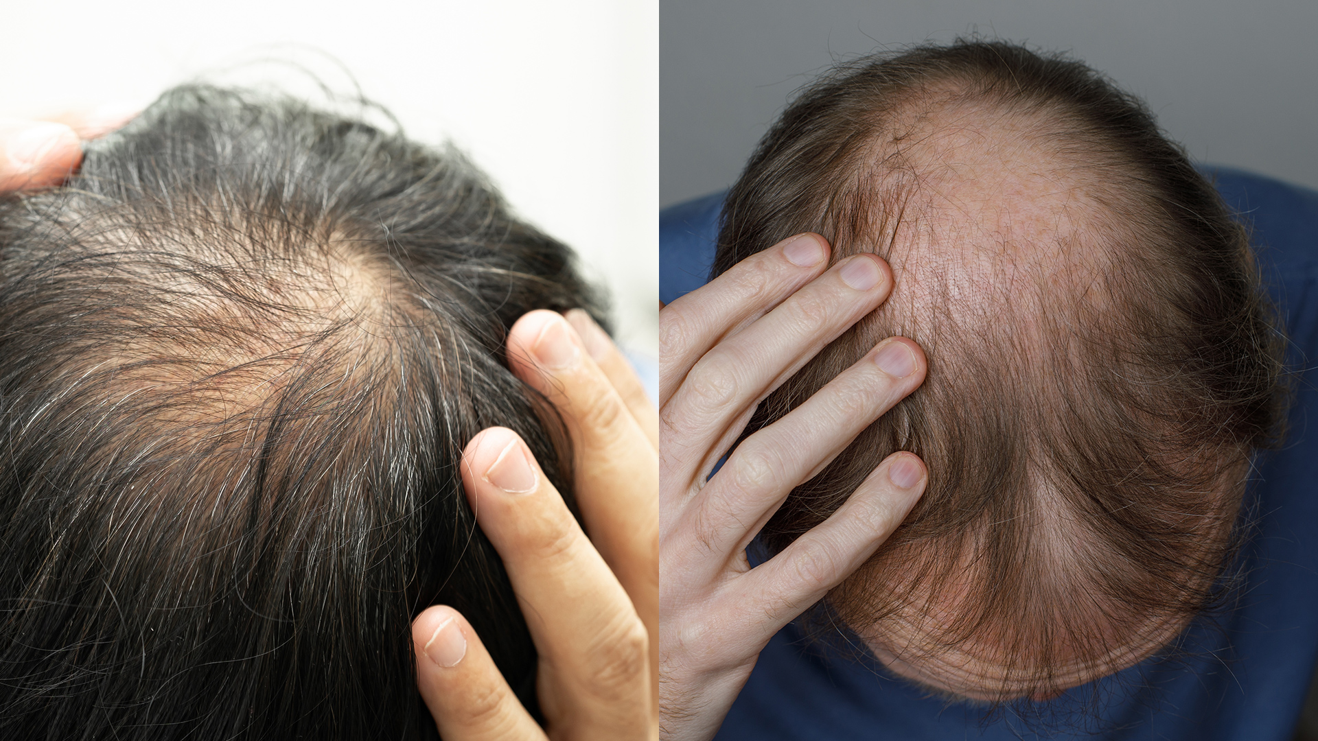 원형탈모 정수리 탈모 차이