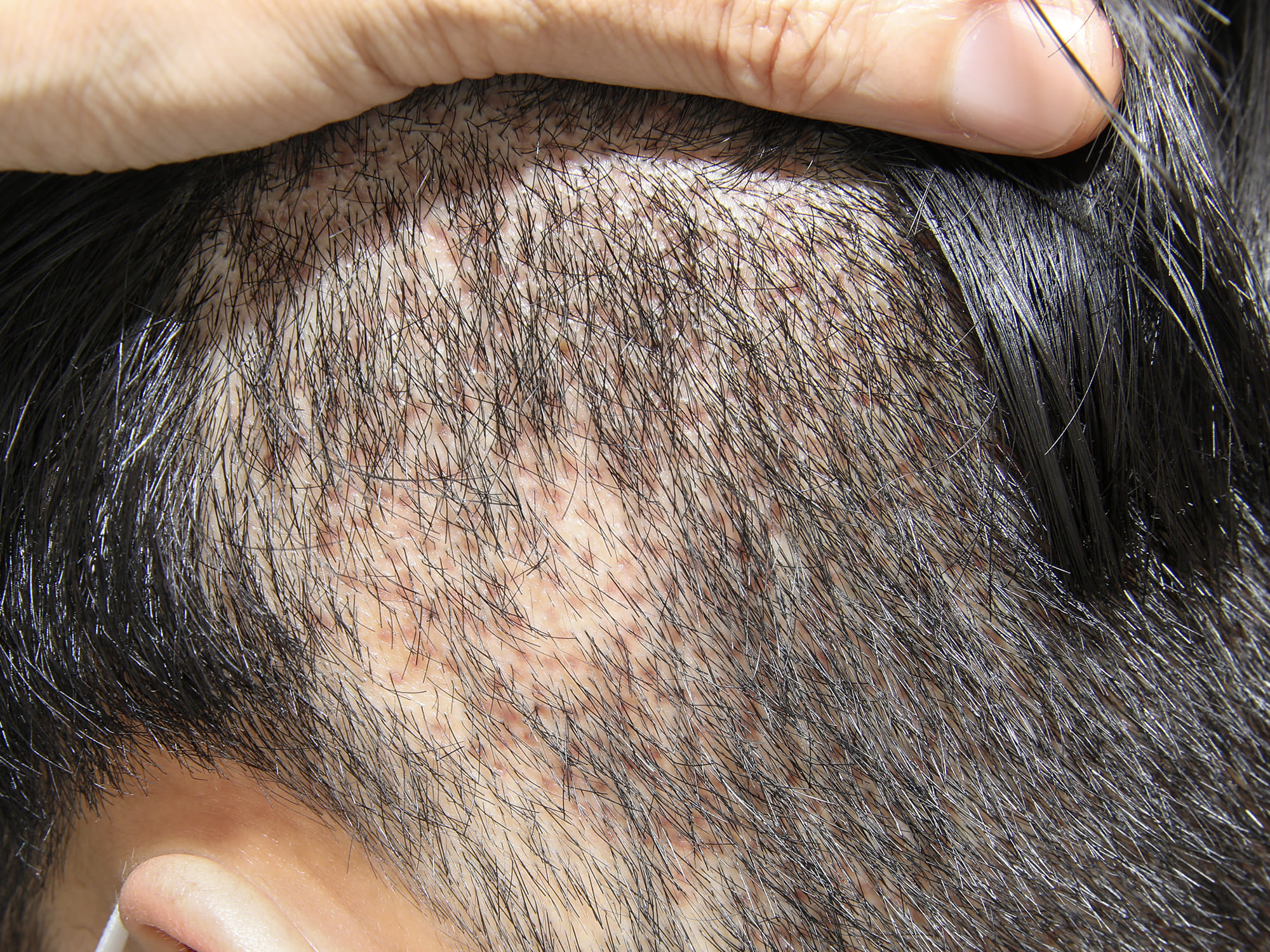 비절개 모발이식 흉터