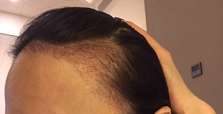 모발이식 암흑기