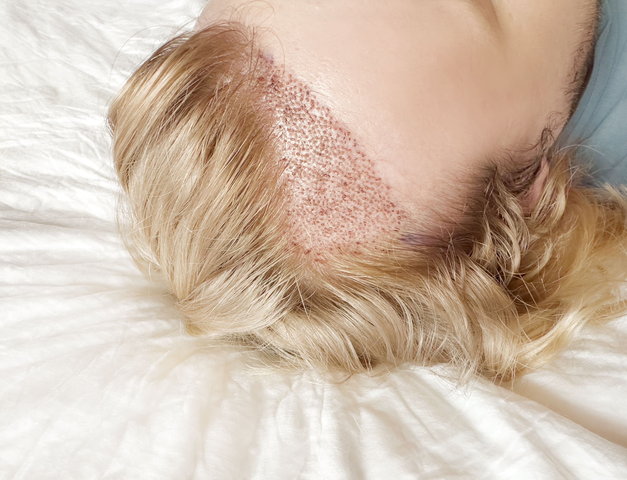 비절개 모발이식 딱지 관리법