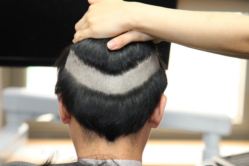 모발이식 부분 삭발
