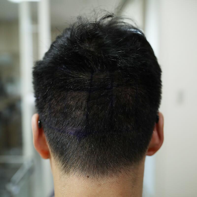 모발이식 무삭발