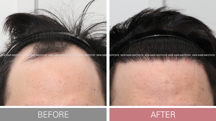 모발이식 후기 사진