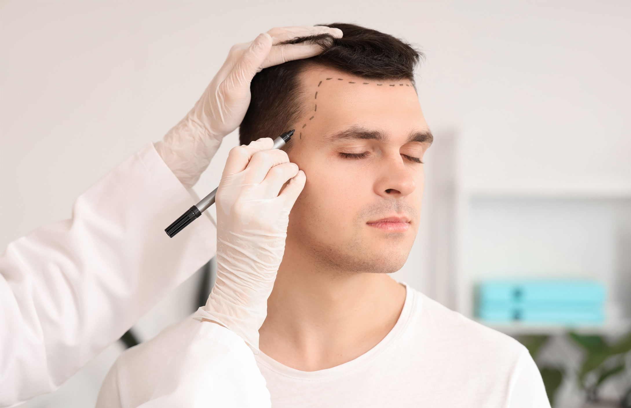 Hair Transplant Newhair