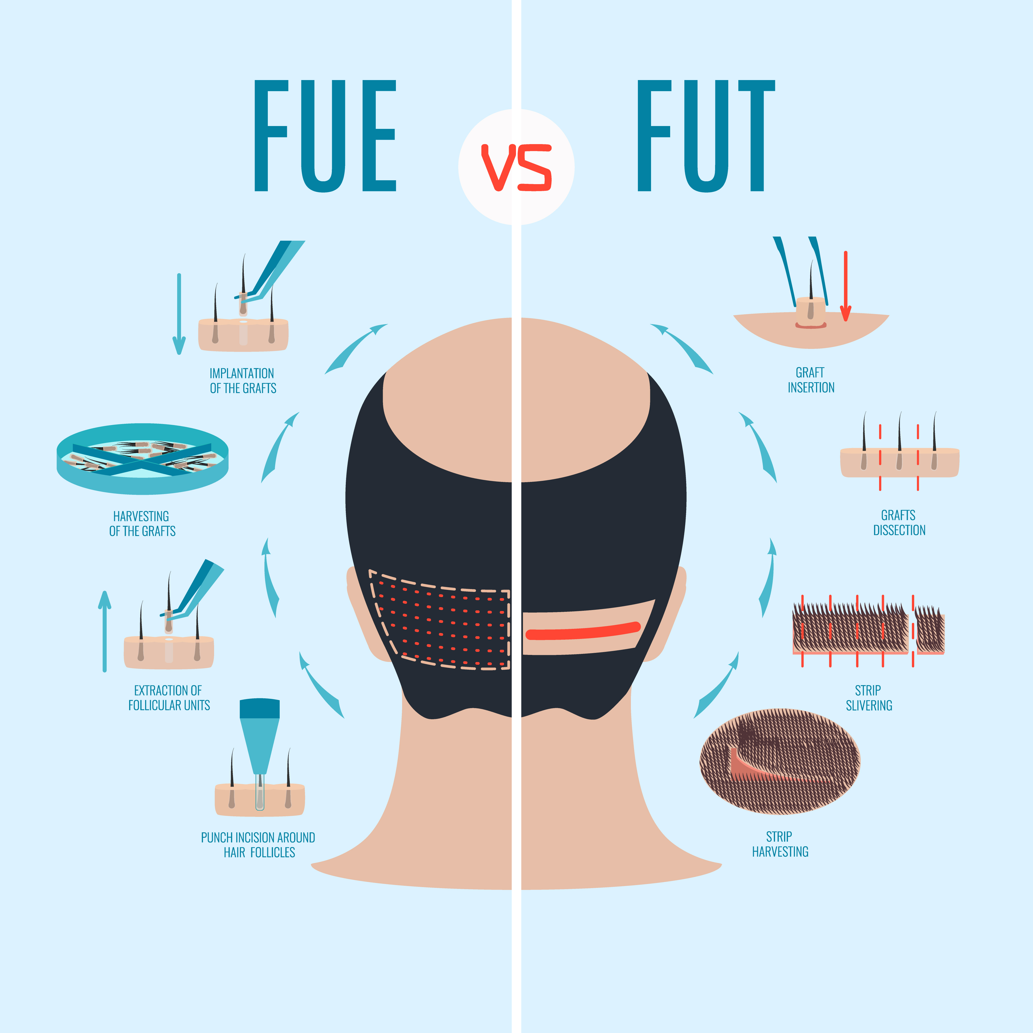 FUT scars vs FUE scars