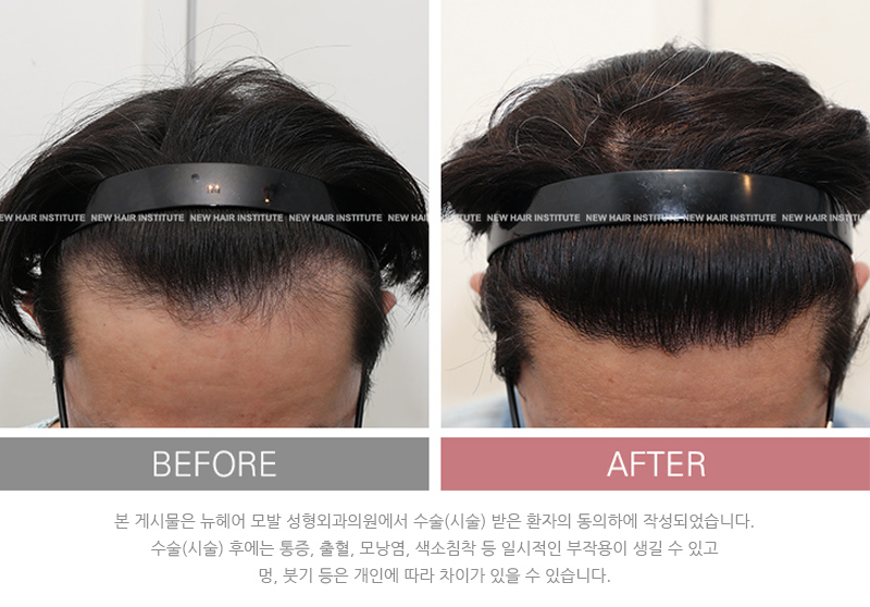 뉴헤어 모발이식 후기