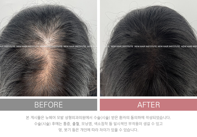 뉴헤어 두피문신 후기