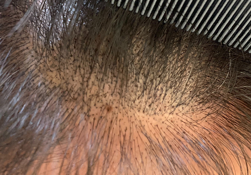 두피문신 SMP 원리