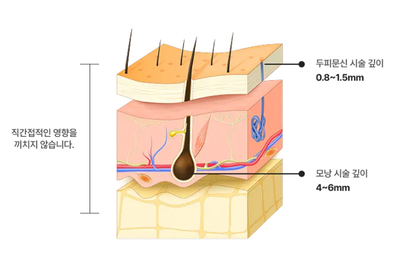 두피문신 SMP 시술 사진