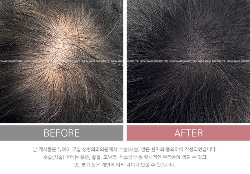 남성 두피문신 SMP 후기