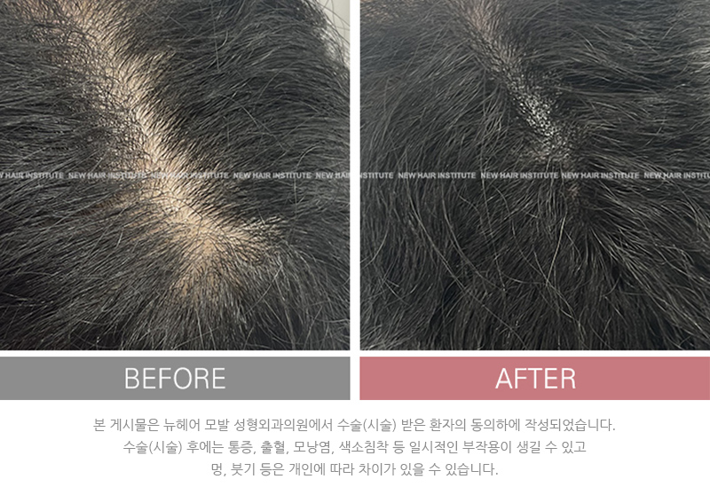 여성 두피문신 후기 사진