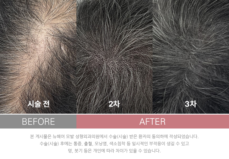 두피문신 리터치 주기