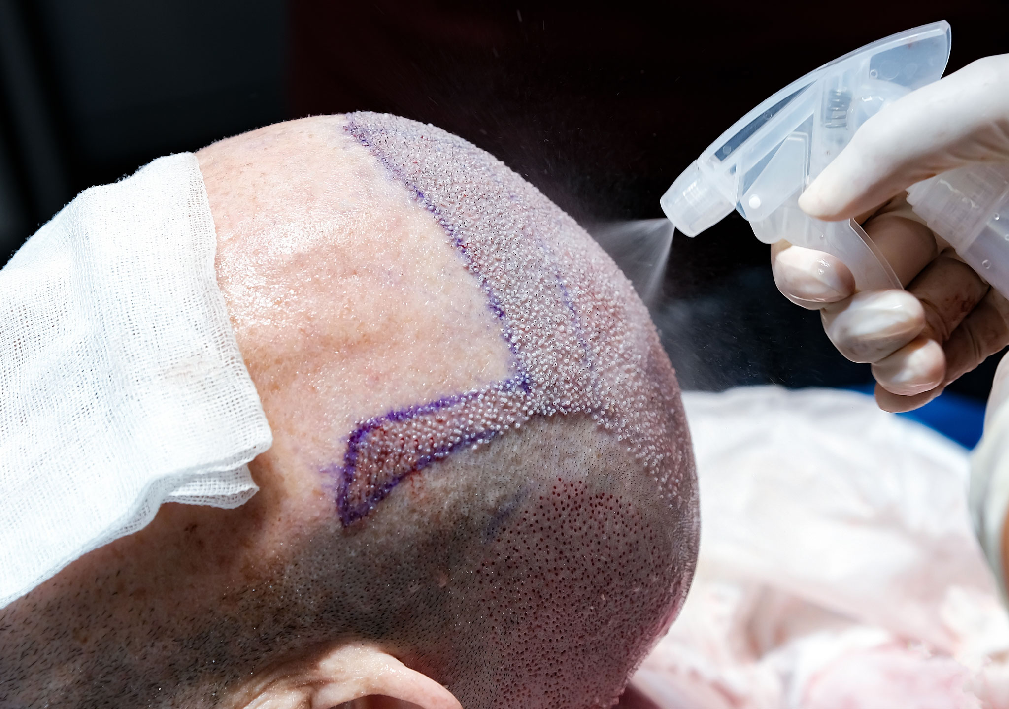 After Hair Transplant, Why swelling happens