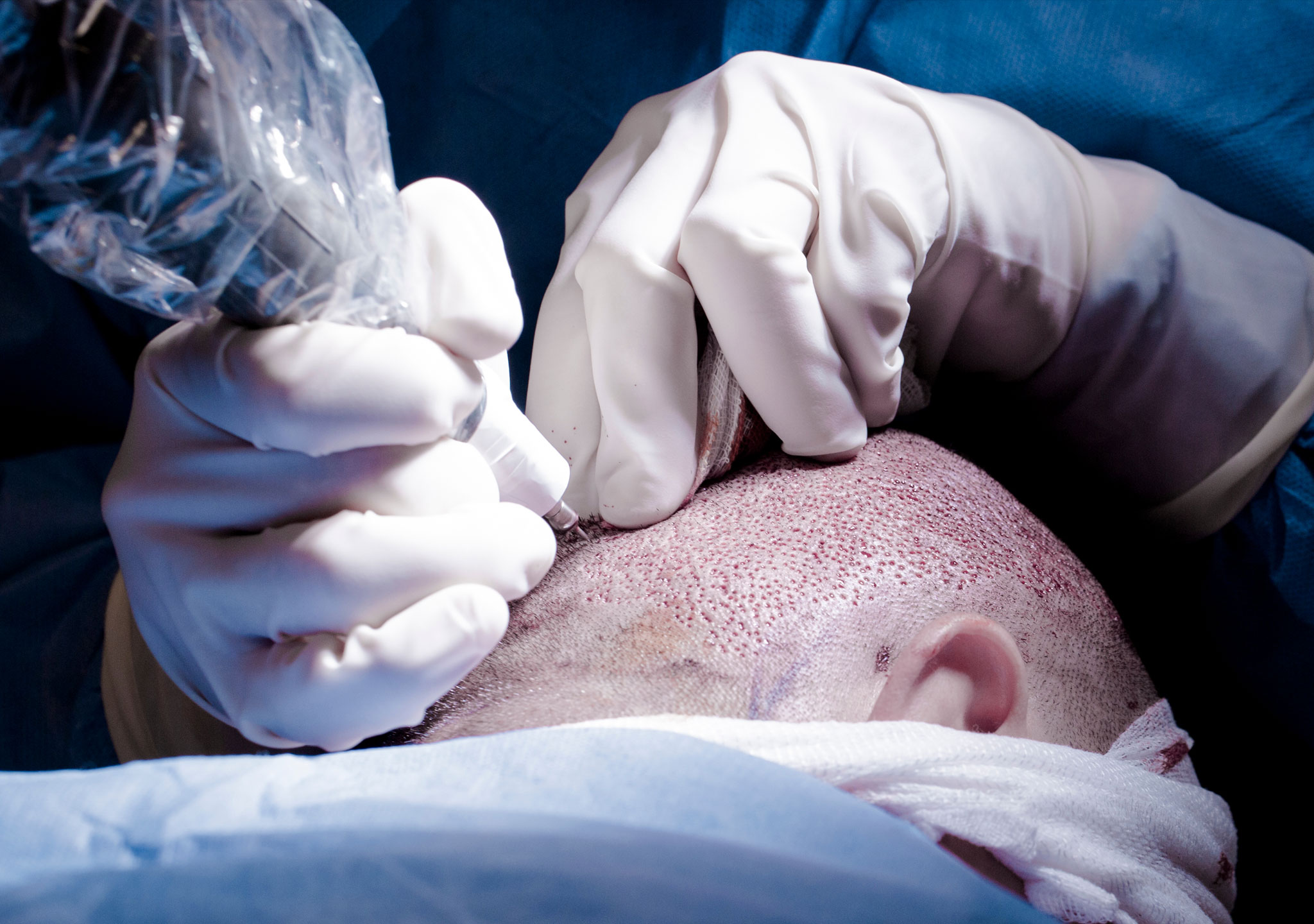 Swelling Timeline After FUE