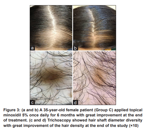 여성탈모에서의 경구 피나스테리드와 국소 미녹시딜 효과 비교